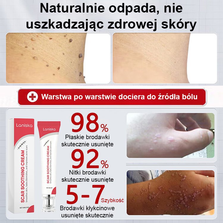 【Jednosekundowy usuwacz brodawek】Krem do usuwania brodawek