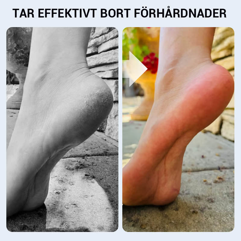 🔥 ﻿Πρακτικό χειροκίνητο εργαλείο αφαίρεσης κάλων για πόδια🦶🏻-GR